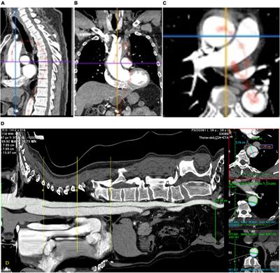 Five-Year Results of Aortic Remodeling for Acute, Subacute, and Chronic Type B Aortic Dissection Following Endovascular Repair